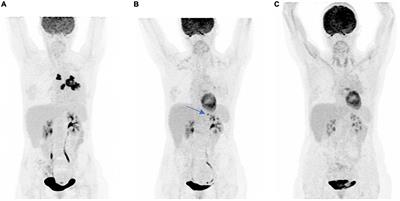 Case report: Eosinophilic fasciitis induced by pembrolizumab with high FDG uptake on 18F-FDG-PET/CT
